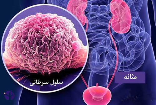 آگاهی و اقدام به‌موقع؛ کلید موفقیت در درمان سرطان مثانه